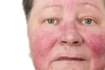 Older woman with a red face as a result of alcohol related rosacea